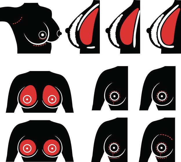 breast i breast i
