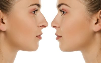 Open Vs. Closed Rhinoplasty