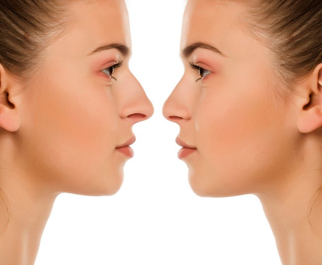 rhinoplasty
