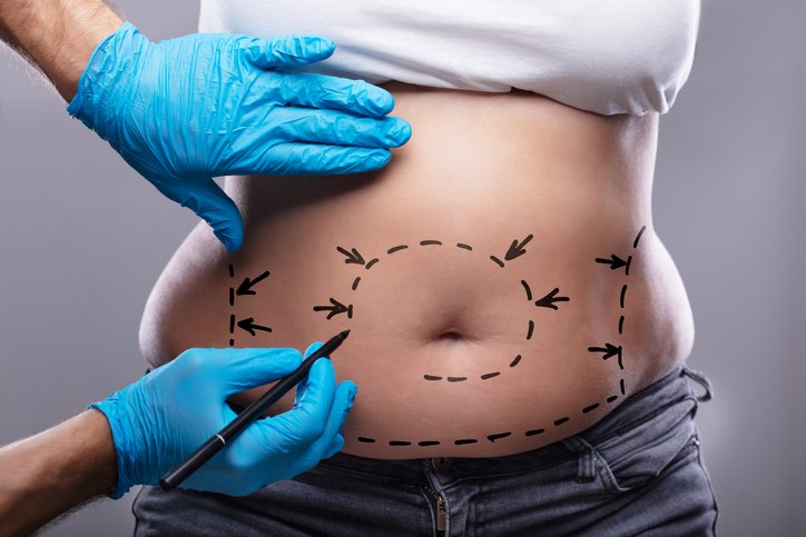 tummy tuck surgeon sd tummy tuck surgeon sd
