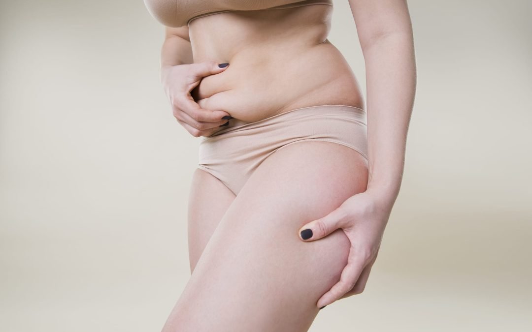 Mini Tummy Tuck Vs Full Tummy Tuck Vs Modified Tummy Tuck