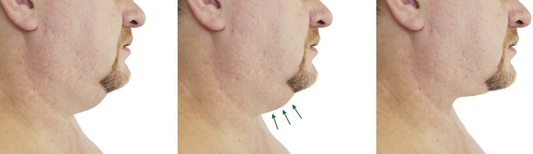 Neck Liposuction in San Diego: Improve Your Look with Facial Plastic Surgery & Cosmetic Surgery