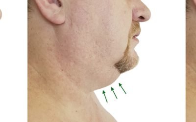 Neck Liposuction in San Diego: Improve Your Look with Facial Plastic Surgery & Cosmetic Surgery