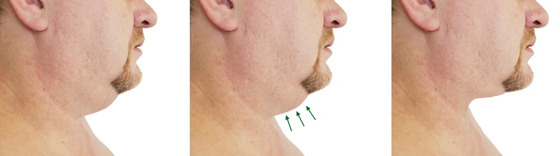 neck liposuction