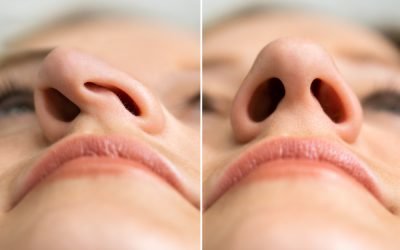 4 Reasons the Nose May Be Crooked and How To Straighten a Deviated Nose