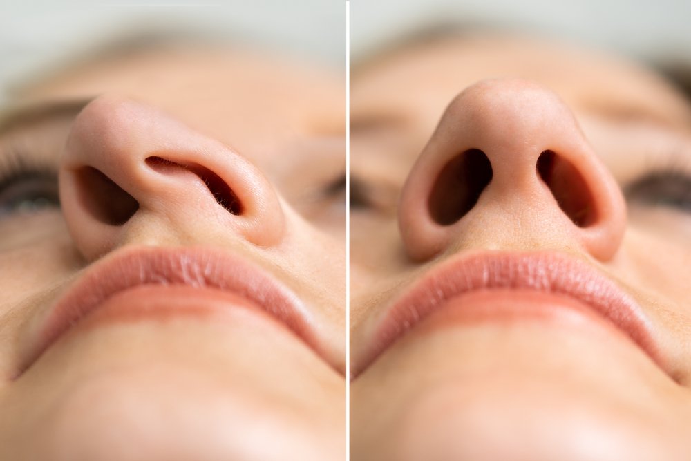 4 Reasons the Nose May Be Crooked and How To Straighten a Deviated Nose