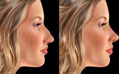 Smoothing the Nose for the Best Rhinoplasty Result