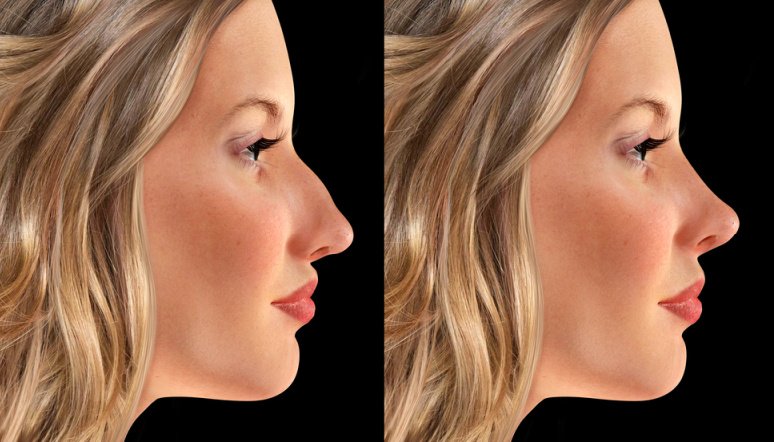 Smoothing the Nose for the Best Rhinoplasty Result