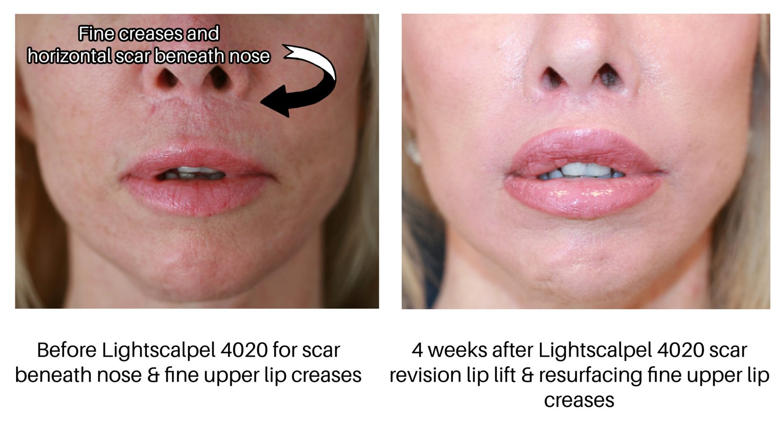Before and After Lightscalpel Lips