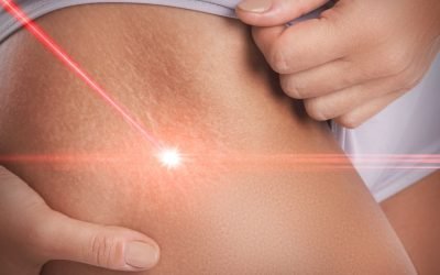 Lightscalpel 4020 : The Best Cosmetic Surgical Laser on Planet Earth