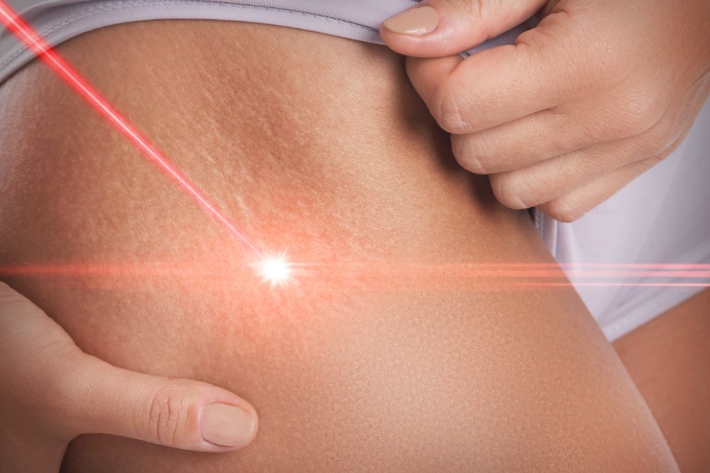 Lightscalpel 4020 : The Best Cosmetic Surgical Laser on Planet Earth