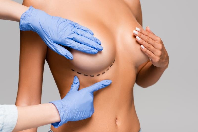 Breast Augmentation for Asymmetry Correction | Fix Unevenness & Lopsidedness