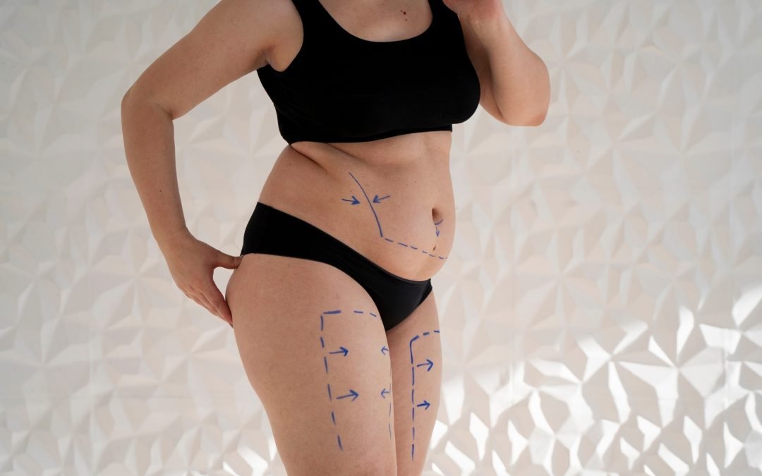 Preparing for Your Body Lift Surgery in San Diego