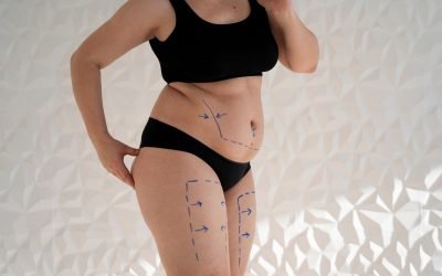 Preparing for Your Body Lift Surgery in San Diego