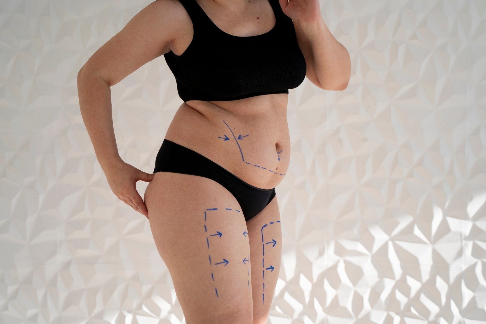 body lift surgery body lift surgery