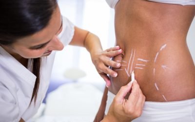 Steps to Prepare for a Body Lift in San Diego After Major Weight Loss