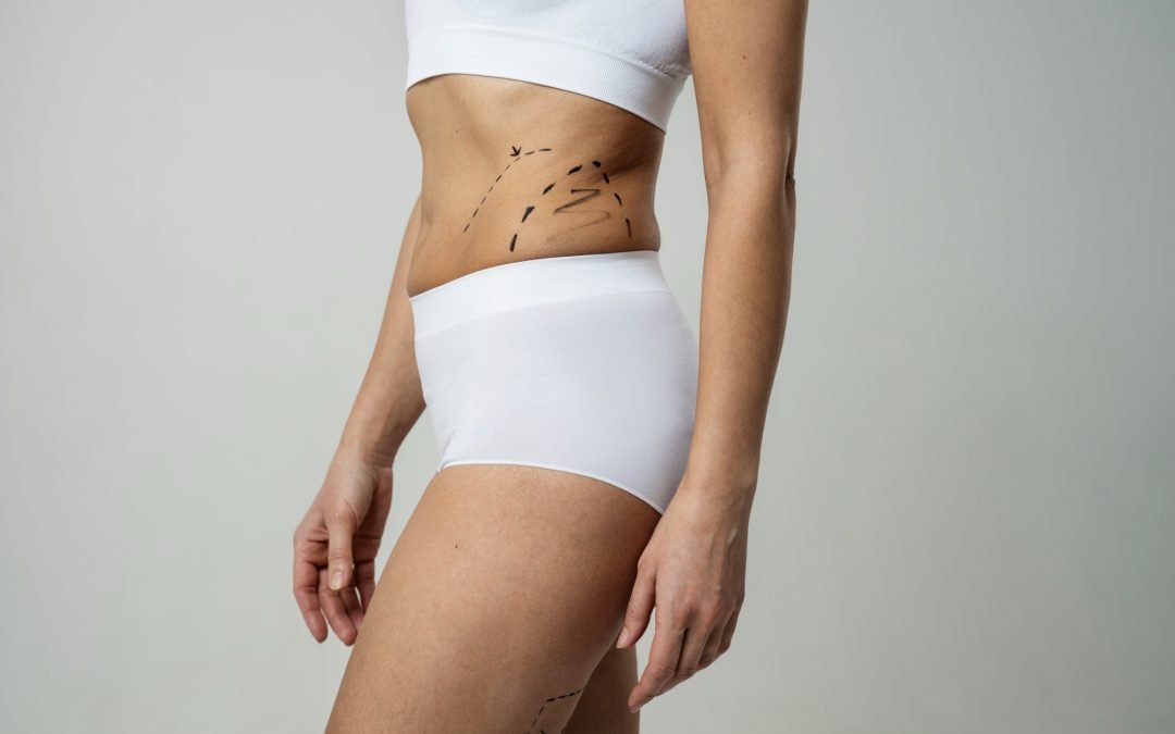 Guide to Planning Your Summer Tummy Tuck in San Diego