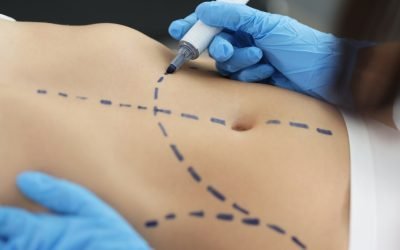 Face vs. Body Procedures in Rancho Santa Fe Explained