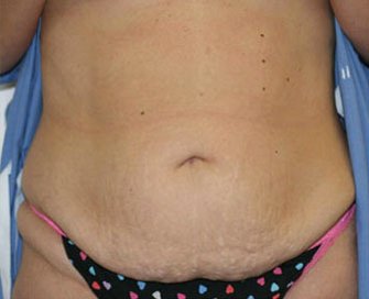 Tummy Tuck Case 1 - before - front