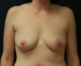 Breast Augmentation San Diego Case 49 - before - front