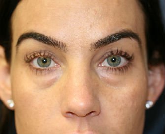 Lower Eyelid Radiesse San Diego - before - front