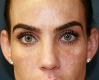 Lower Eyelid Radiesse San Diego - after - front