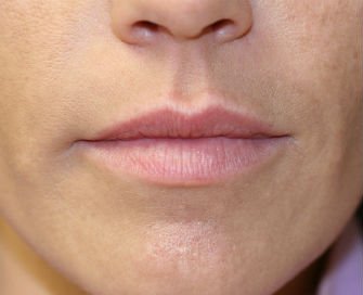 Lip Augmentation with Juvederm, San Diego - before - front