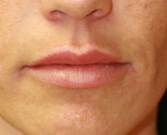 Lip Augmentation with Juvederm, San Diego - after - front