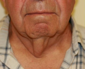 Necklift San Diego Case 12 - before - front