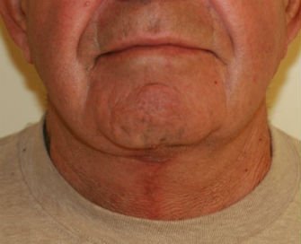 Necklift San Diego Case 12 - after - front