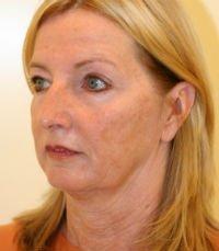 Facelift San Diego Case 15 - before - oblique