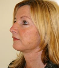 Facelift San Diego Case 15 - after - oblique