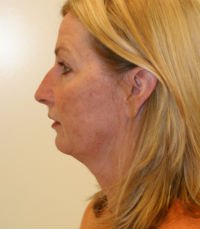 Facelift San Diego Case 15 - before - side