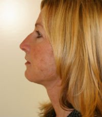 Facelift San Diego Case 15 - after - side