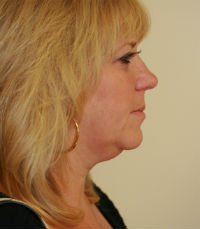 Necklift San Diego Case 14 - before - front