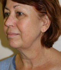 Necklift San Diego Case 15 - before - oblique