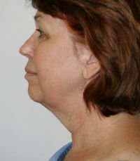 Necklift San Diego Case 15 - before - front