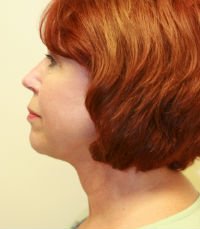 Necklift San Diego Case 15 - after - front