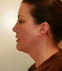 Neck Liposuction San Diego Case 16 - before - front