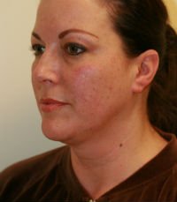 Neck Liposuction San Diego Case 16 - before - oblique