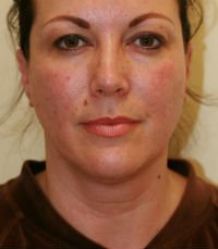 Neck Liposuction San Diego Case 16 - before - side