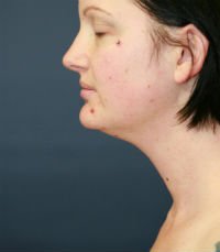 Neck Liposuction San Diego Case 17 - before - front