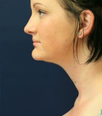 Neck Liposuction San Diego Case 17 - after - front