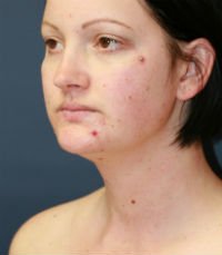 Neck Liposuction San Diego Case 17 - before - oblique