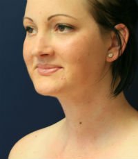 Neck Liposuction San Diego Case 17 - after - oblique