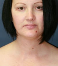 Neck Liposuction San Diego Case 17 - before - side
