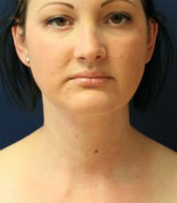 Neck Liposuction San Diego Case 17 - after - side