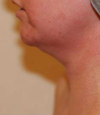 Neck Liposuction San Diego Case 18 - before - front