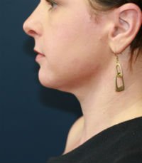 Neck Liposuction San Diego Case 18 - after - front