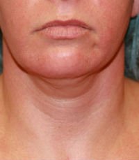 Neck Liposuction San Diego Case 18 - before - side